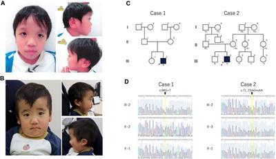 Functional analysis of RRAS2 pathogenic variants with a Noonan-like phenotype